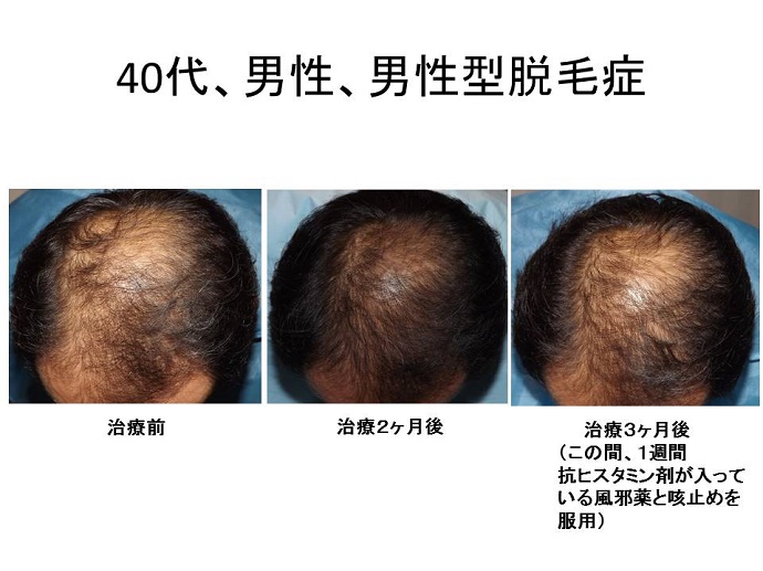 円形脱毛症　病院""